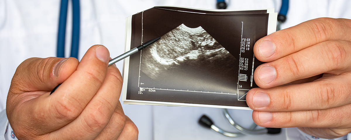 אנגיומיוליפומה AML - resized