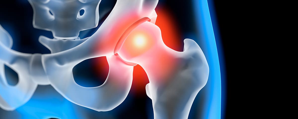 ניתוח החלפת מפרק ירך